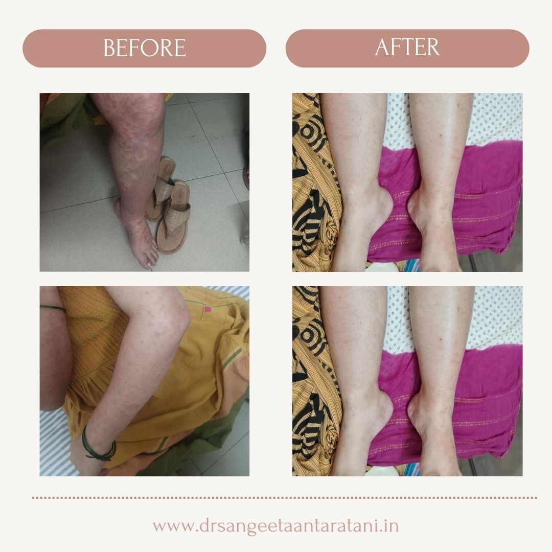 a-case-of-polymorphic-eruption-of-pregnancy-pep-treated-by-dr-sangeeta-antaratani-at-sushrutha-hospital-hubli-thumbnail