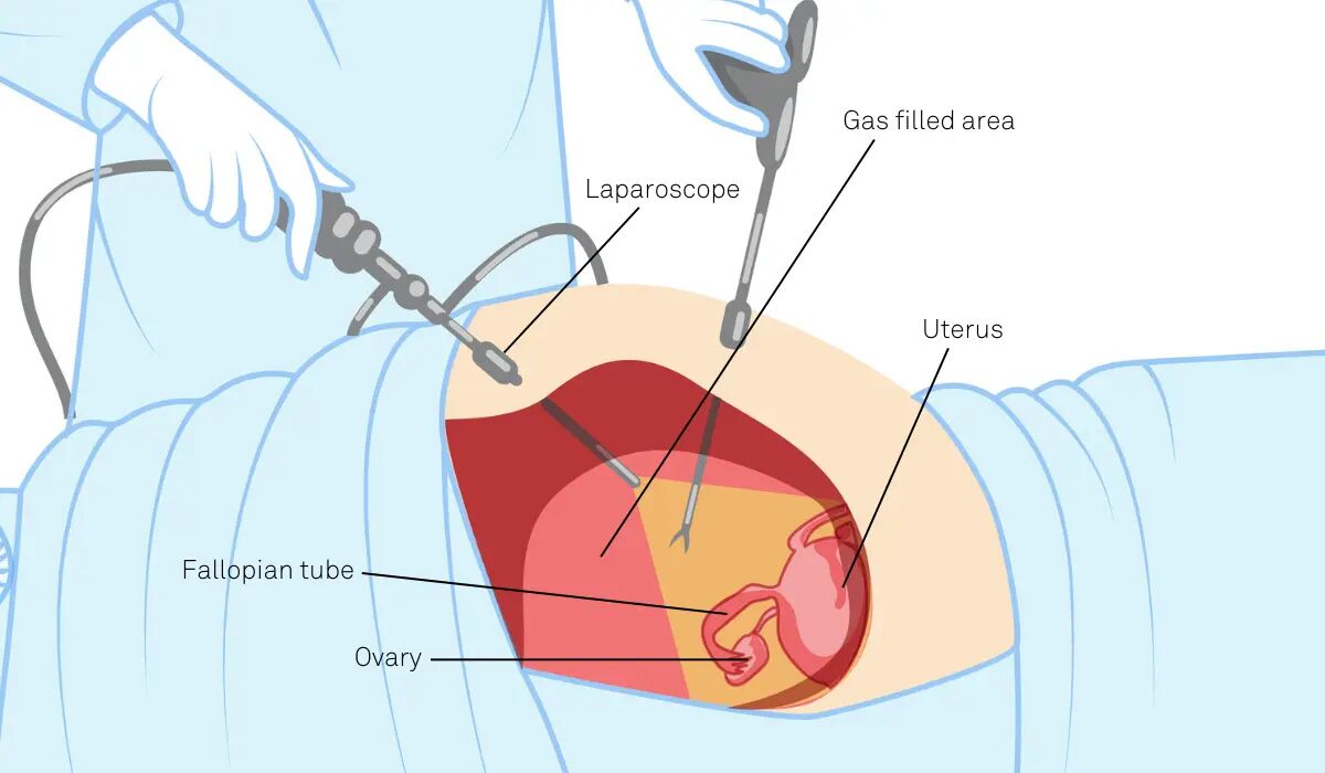 rare-laparoscopic-surgery-during-pregancy--a-case-by-drsangeeta-antaratani-thumbnail