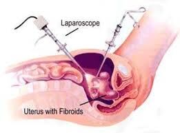 fibroid-uterus-removed--case-by-dr-sangeeta-antaratani--gynaecologist-in-hubli-thumbnail